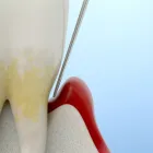歯周病